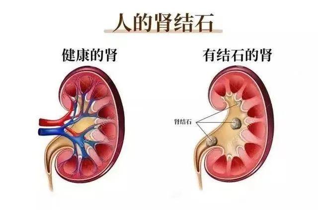 多年結石終惹禍失去腎臟真兇仍隱匿體內