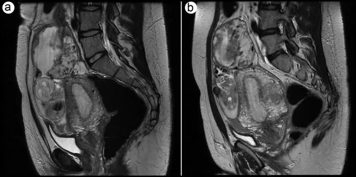 美国德州农工大学医疗中心报告一例矢状腹腔妊娠，胎儿脊柱可见。图源/Proc（Bayl Univ Med Cent）