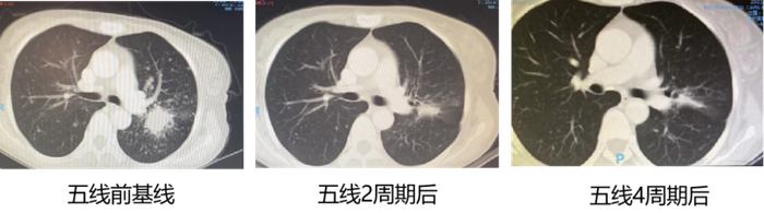 图4. 患者五线治疗前后CT变化对比图。