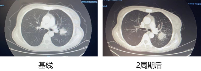 图3. 患者四线治疗前后CT变化对比图。