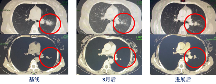 图1. 患者入院前的一、二线治疗过程中复查的CT变化对比图。