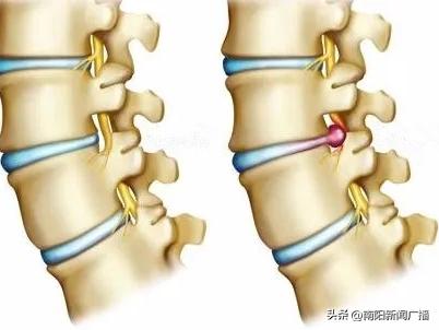 天天健康腰椎間盤突出症患者的健康宣教
