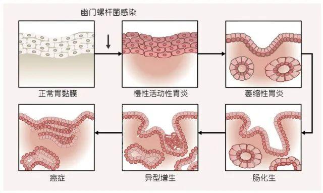 目前普遍認為胃癌是由:正常胃黏膜>慢性淺表性胃炎>萎縮性胃炎>腸上皮