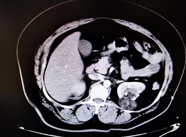 左肾错构瘤图片