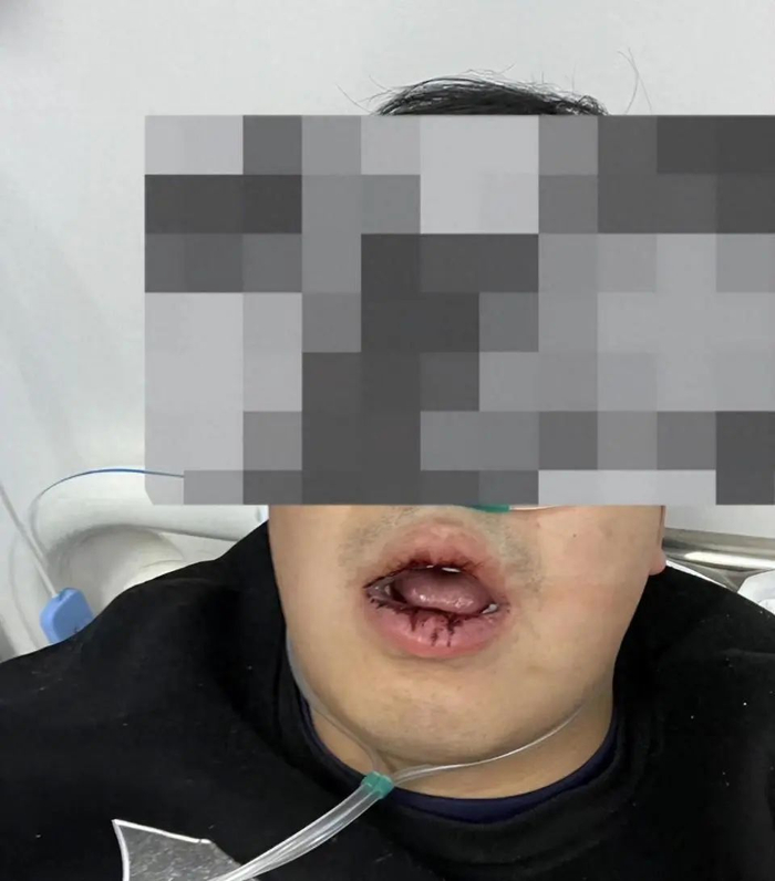 马先生被扇巴掌后，口唇出血结痂（受访者供图）