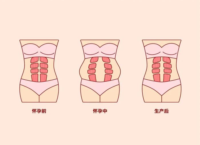 腹白线图片怀孕图片