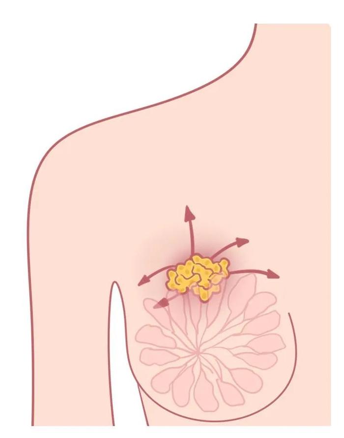 忍一時乳腺增生退一步卵巢囊腫別生悶氣了再不改變真的會死