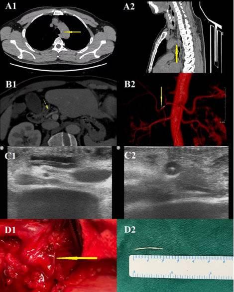 2釐米魚刺經吞嚥遊走至肝動脈看血管外科專家如何化險為夷
