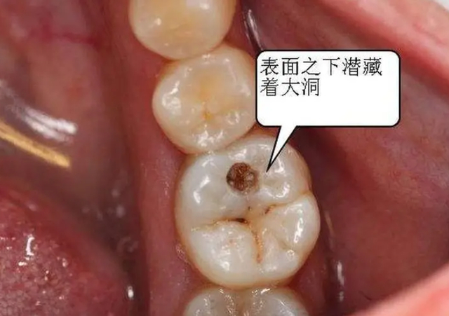 得了牙髓炎为什么不痛也得治?|牙髓炎|牙髓|急性期_新浪新闻