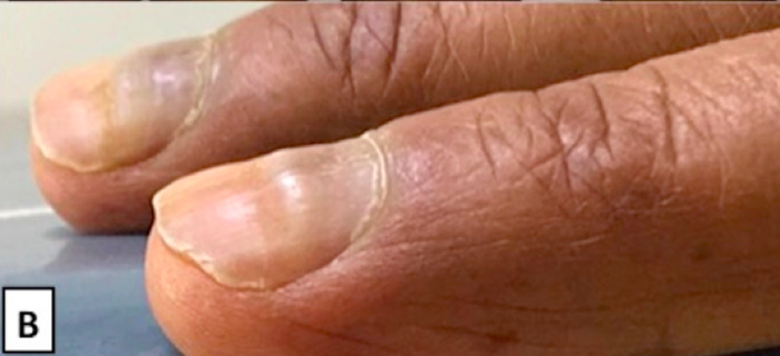真要担心的指甲是这样的……|维生素_新浪新闻