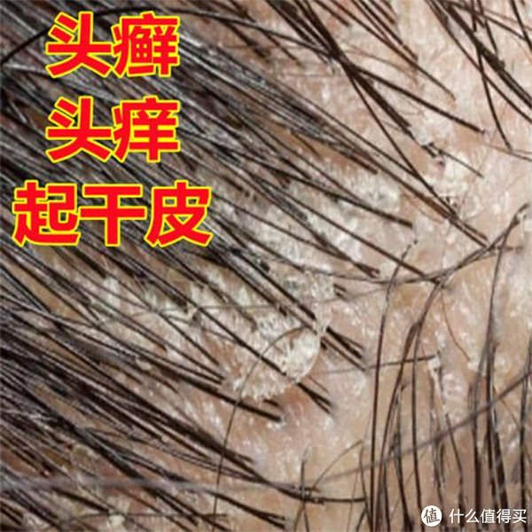 头皮屑多用什么洗发水效果好?洗发水去屑止痒效果排行榜最好|头皮屑_新浪新闻