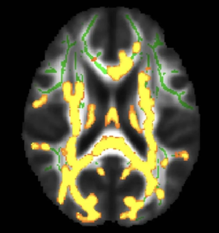 脑部扫描显示隐藏的内脏脂肪水平较高，神经炎症（黄色）增加