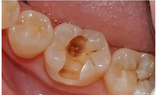 牙髓|蛀牙|牙齿_新浪新闻