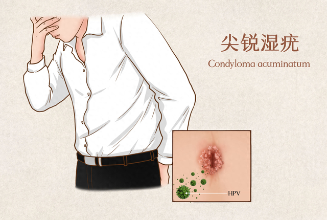 光动力显身手|疾病|尖锐湿疣_新浪新闻