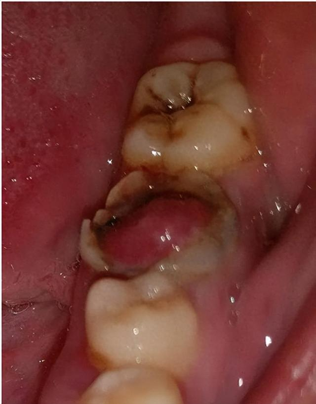 牙髓息肉怎么治疗?|棉球_新浪新闻