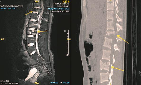             右上图：术前CT示胸腰椎多发爆裂性骨折伴移位          