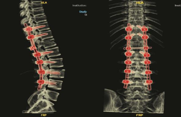             右下图：术后CT示椎体内固定位置稳定，骨折端对位、对线好          