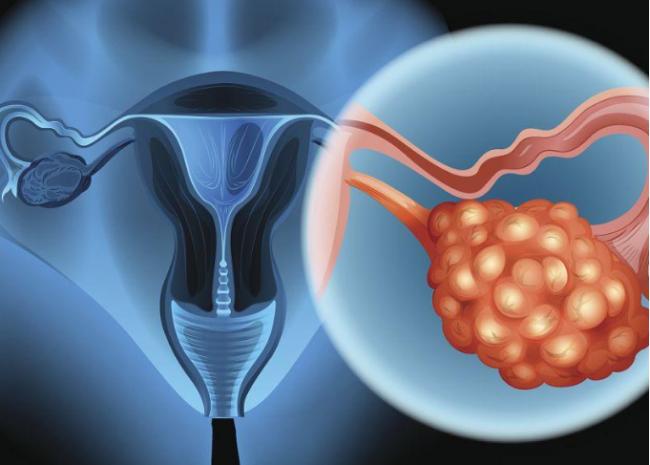 西安生殖保健院不孕不育醫院卵巢多囊綜合症怎麼樣才能懷孕