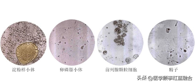显微镜下的前列腺液