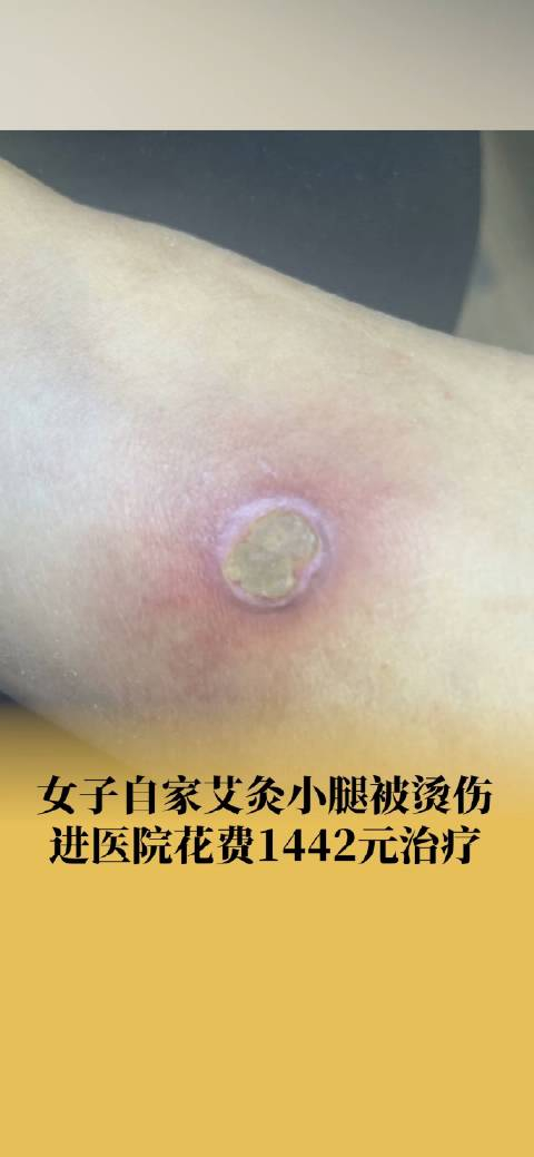 女子在家艾灸被烫伤就医花1442