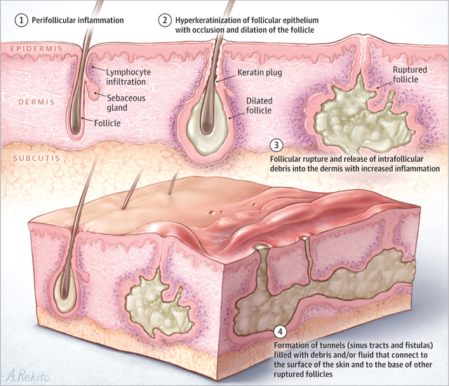 HS在毛囊的发病进程。图片来源：【5】