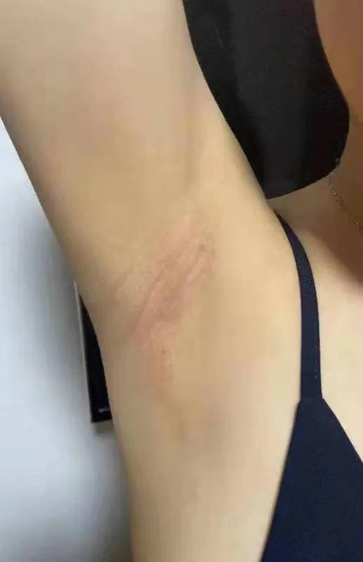 宁津县人民医院腋窝开个小切口甲状腺肿瘤切无痕