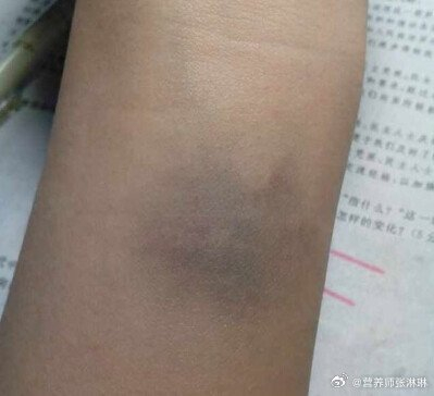 身上为什么总有莫名的淤青淤青是因为皮下出血造成的红肿