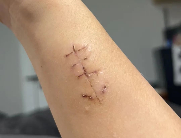 难以避免尿毒症的肾病类型,我在透析后继续工作,成家!