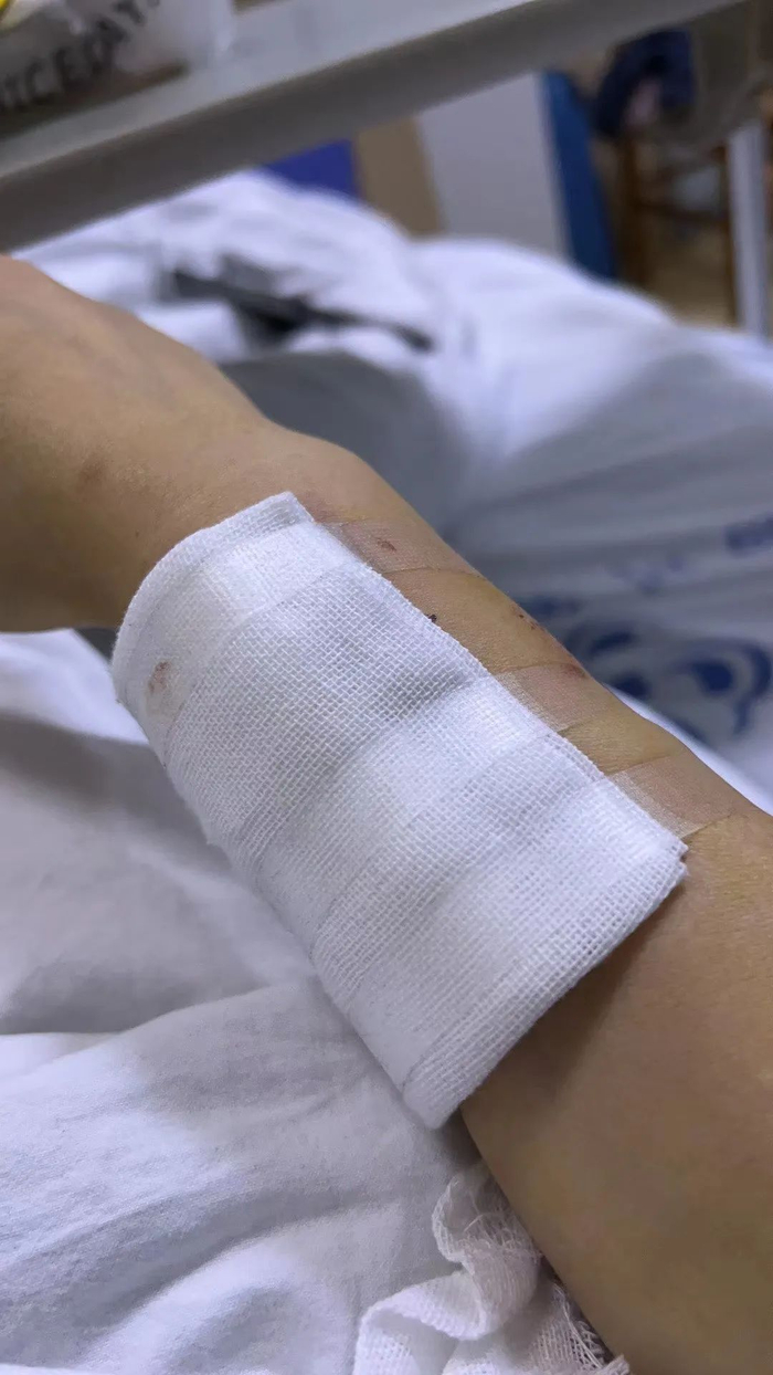 反而更严重了,5月底拿到检查指标,医生就让我住院,造瘘,准备透析