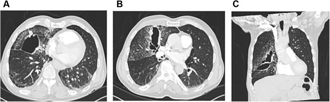 图1 三个月前王大爷的外院CT检查图像
