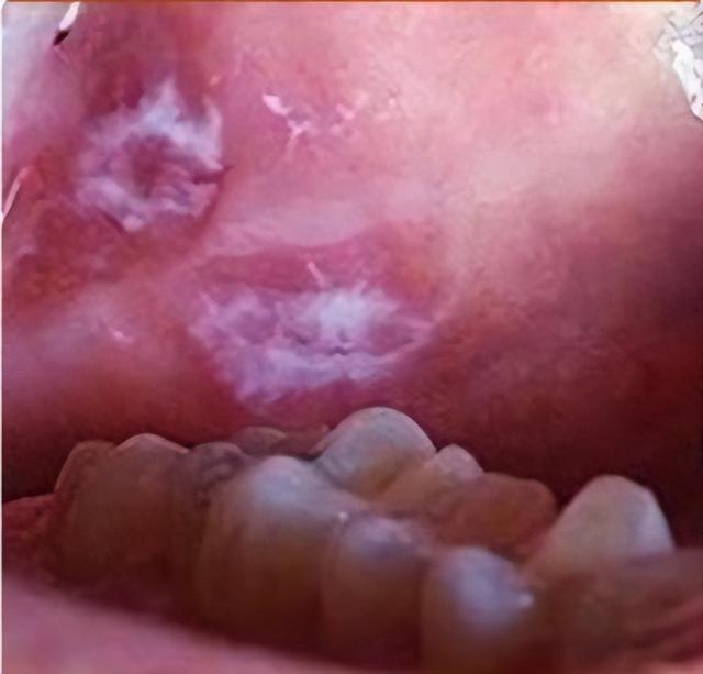 口腔黏膜中的白斑病是什么?