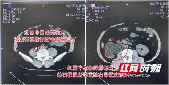 男子腰部偶有脹痛卻漠然置之 近期檢查發現右腎被結石