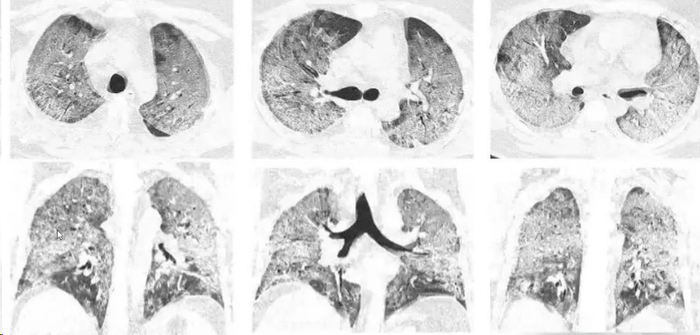 图2 “白肺”患者胸部CT