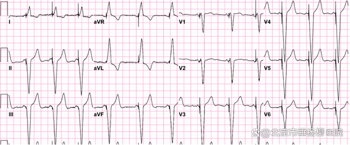 ▲传统右室起搏及起搏后心电图