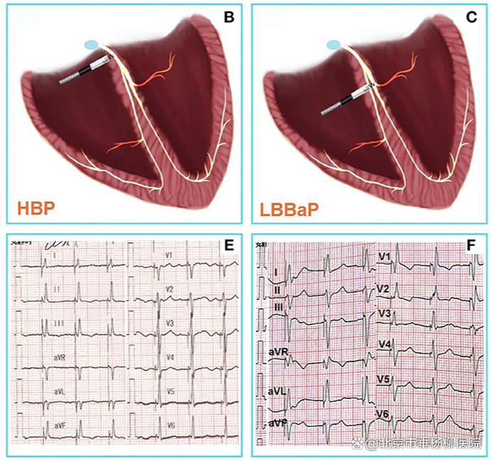 ▲希氏束起搏与左束支起搏