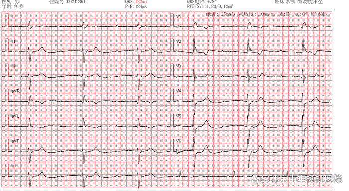 ▲术前心电图示III度房室传导阻滞