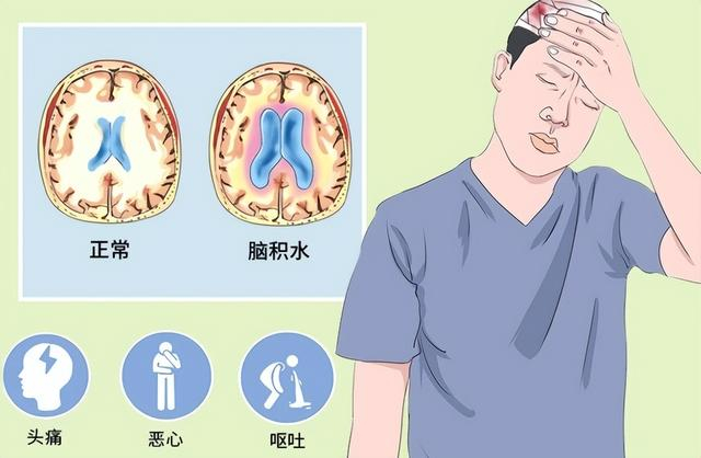 脑积水|老年痴呆|脑室_新浪新闻
