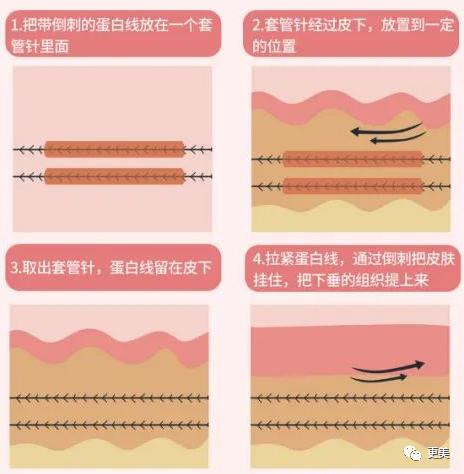 二,軟組織下垂方向與皮膚下垂方向不完全一致,脂肪與皮膚同時