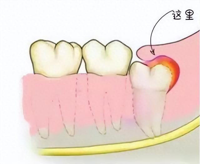 下颌智齿经常发炎