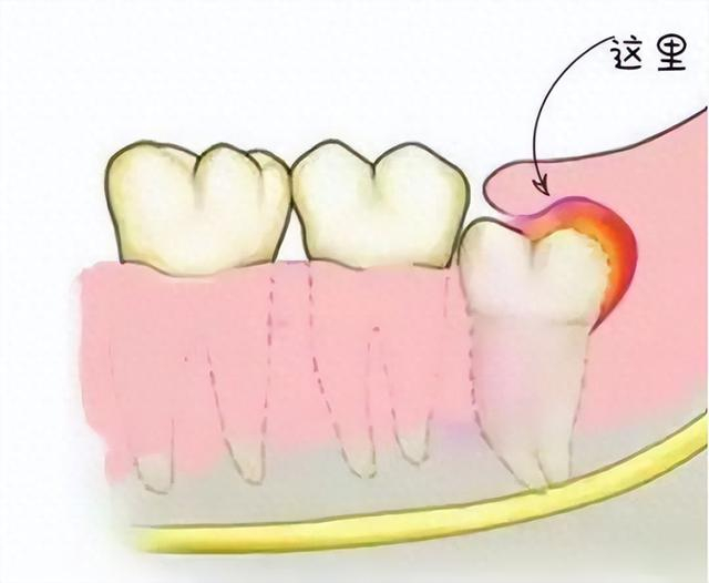 下颌智齿经常发炎,原来是盲袋搞的鬼|智齿|牙龈|下颌_新浪新闻
