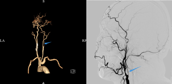 手术现场及取出的斑块血栓