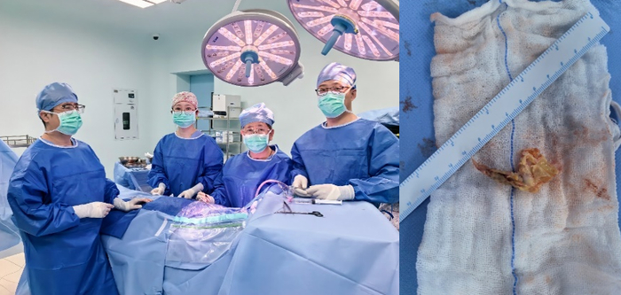 手术现场及取出的斑块血栓