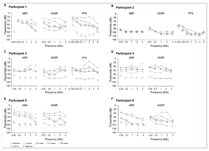 （图：AAV1-hOTOF基因治疗前后的受试者听力）