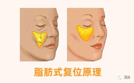 右:皮膚狀態好好,口角囊袋和蘋果肌已經移位了這就有了新技術的第一