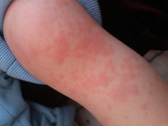 3月23日患儿全身皮疹,请皮肤科会诊,考虑病毒疹,予以口服蒲地蓝