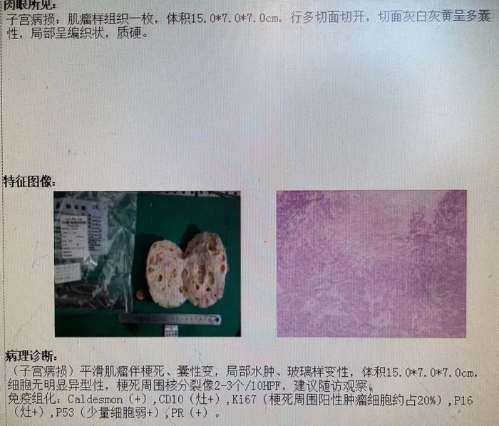 图1：术后病理结果/作者供图