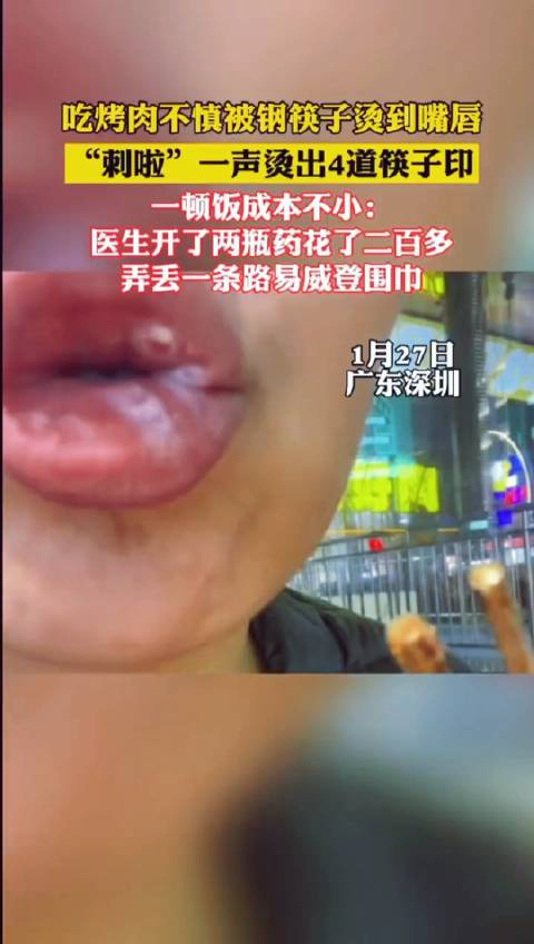 女子吃烧烤嘴唇被钢筷子烫出4道伤__财经头条