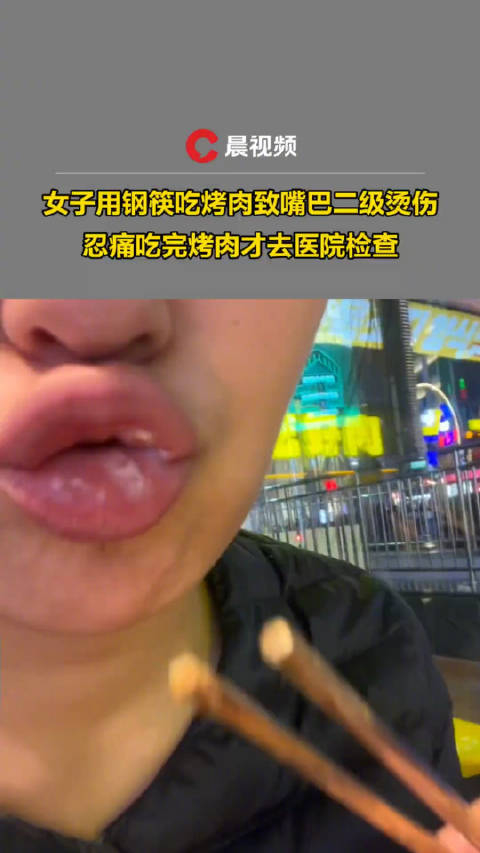 女子用钢筷吃烤肉致嘴巴二级烫伤忍痛吃完烤肉才去就医