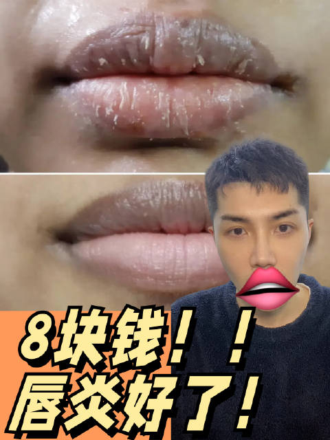 8块钱搞定干裂起皮唇炎每年冬天都会撕拉式唇炎