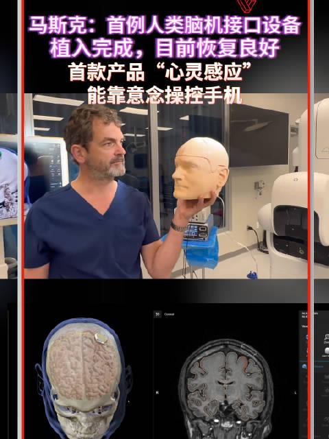 马斯克首例人类脑机接口设备植入完成目前恢复良好首款产品心灵感应能
